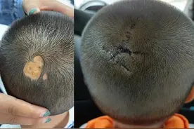 4岁幼童头顶瘢痕脱发 医生巧手让发“再生”图片