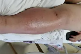 气温高蚊虫多，杭州孕妈被叮咬后，胎儿命悬一线，紧急剖宫产图片