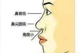 济南海峡整形科普：为什么做了隆鼻，鼻子还是不好看？图片