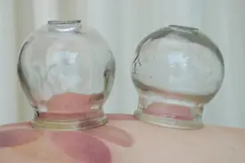 拔火罐怎么用有讲究 拔后不宜马上洗澡图片