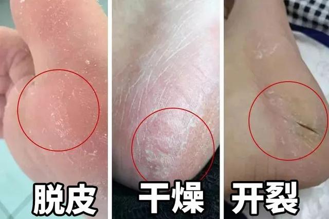 身体乳可以擦脚足部吗