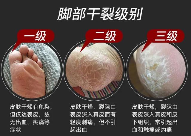 身体乳可以擦脚足部吗