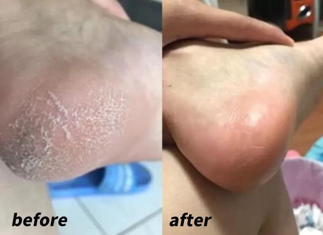 身体乳可以擦脚足部吗