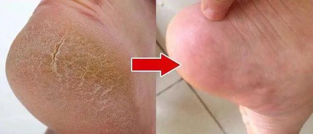 身体乳可以擦脚足部吗