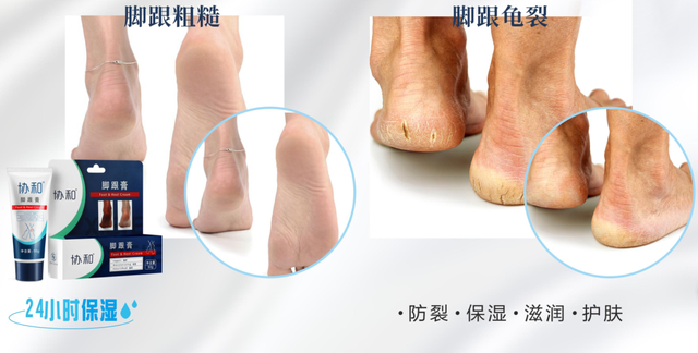 身体乳可以擦脚足部吗