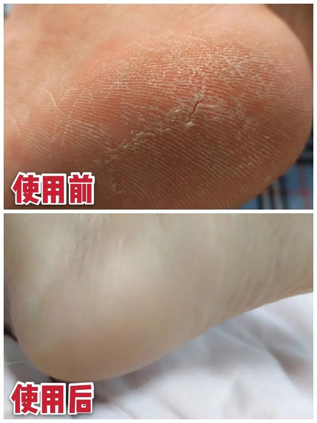 身体乳可以擦脚足部吗