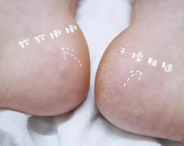 身体乳可以擦脚足部吗