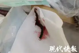 女子睡梦中疼醒，医生一查，耳朵里竟有一条5厘米的蜈蚣图片