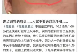 又是它！女子半夜关灯玩手机，险些致毁容……图片
