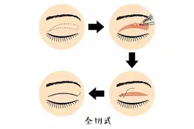 济南海峡整形分享：为什么你做的双眼皮不如别人好看？图片