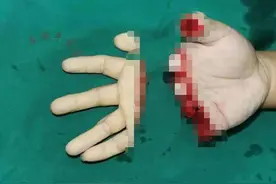 断掉半截手掌！因操作机器不慎，小伙送往医院接上断掌图片