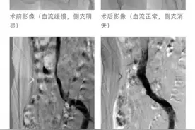 心脉医疗™首款静脉领域产品顺利完成上市前临床试验受试者入组图片