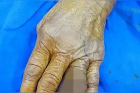 因为一条10块钱的鲈鱼，宁波女子治病花掉10万元！手指也被截掉图片