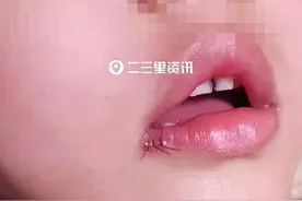 男童在辽源四百货蓝天幼儿园内伤到嘴角，园方：走法律程序图片