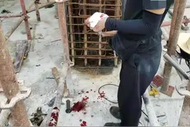 扎心！这名务工人员在汕尾因工受伤，索赔太难图片