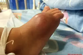 8个月宝宝进ICU，只因家长帮他挤了个脓包图片
