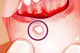 不说虚的！这次认真说说“口腔溃疡”怎么治图片