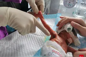出生1斤1两，经历窒息骨折感染，“巴掌宝宝”完成生命闯关图片