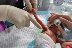 出生1斤1两，经历窒息骨折感染，“巴掌宝宝”完成生命闯关图片
