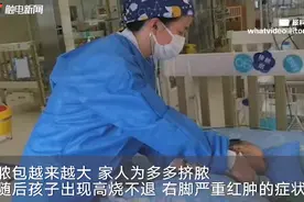 长沙一家长为婴儿挤脓包，结果送进ICU！医生提醒：类似情况需到医院就诊图片