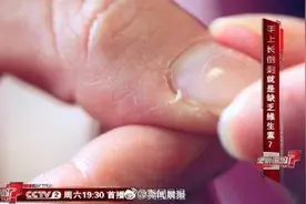 提醒！手撕倒刺后果很严重！或致败血症、骨髓炎……图片