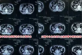 兄弟俩患肾结石先后住同一病房，医生：结石具有家族性特点图片