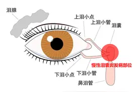 莫名流泪1年还流脓，原来眼睛里的泪囊也会发炎……图片