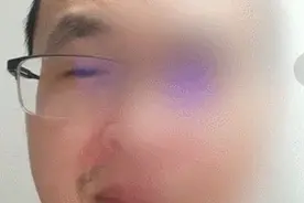 男子眼皮底下一直跳，到医院一查：结果惊出冷汗…图片