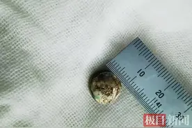 3岁男童吞下电池灼穿小肠，电池取出时腐蚀成“金属疙瘩”图片