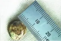 误吞后腐蚀肠道致肠穿孔 一颗纽扣电池险些要了男童命图片