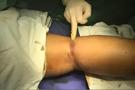 老人鱼刺卡喉吞饭强行咽下，刺破肠壁进入血管“寄居”图片