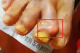 这两种食物经常一起吃，福州一依伯差点截肢图片