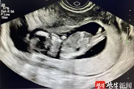 怀孕13周查出胎儿是极罕见“美人鱼”病例！专家提醒，按时产检尽早发现胎儿异常图片