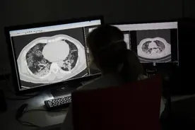 晚期非小细胞肺癌患者有新希望，又一新药获批临床试验图片