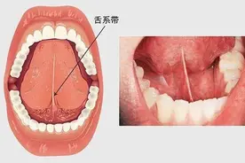 孩子舌系带过短？宝爸宝妈们要注意啦图片