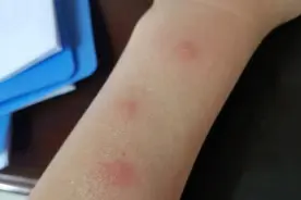 御寒衣被不洗不晒就“上岗”？小心皮肤病图片