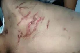 山东莘县6岁男童遭狗撕咬事件后续：出院后治疗费未谈拢，家属刑事控告狗主人图片