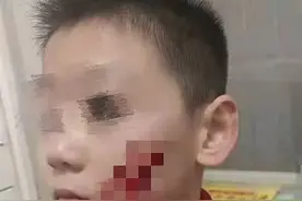 吴起一小学生校内被同学划伤面部，缝了7针图片