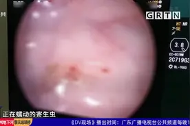 中山：少女肠道内布满寄生虫 疑因长期吃鱼生所致视频封面