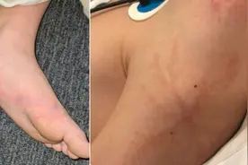 澳大利亚男孩被闪电击中 因穿橡胶底鞋幸免于难图片