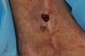 抠了一下，杭州大伯“蚯蚓腿”喷血到休克！专家：静脉曲张不只是美观问题图片