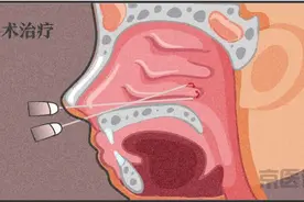 过敏性鼻炎能根治吗？这篇文章终于说透了！图片