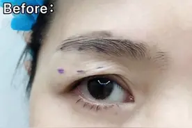 35岁-60岁，最值得做的一个整容项目：提眉手术图片
