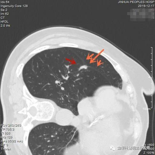 叶建明谈结节：检查发现肺实性结节怎么办？个人版实用指南
