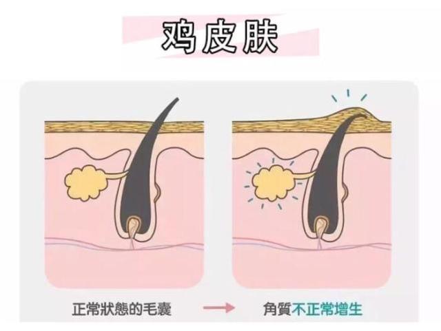 颈部皮肤鸡皮样图片
