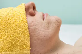 胸前的疤痕疙瘩怎么去除？图片