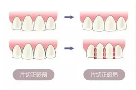 牙齿矫正为什么要片切？是切哪？疼吗？图片