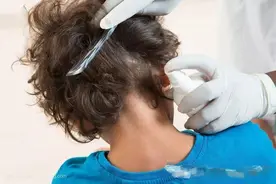 女儿头上长了许多虱子，宝妈用热夹板把头发烫了烫，结果很舒适图片