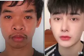 相貌不佳找工作屡碰壁 越南小伙数次整容蜕皮成美男走红泰网图片