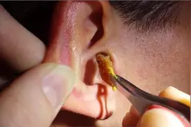 你知道么？耳屎其实是液体！医院也有专门掏耳屎的地方哦图片